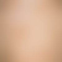 Mastocytosis diffuse of the skin: Disseminated large-area mastocytosis of the skin (type Ia); no ...