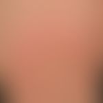 Urticaria pigmentosa: classic form of urticaria pigmentosa (type I). disseminated, flat, oval or ...