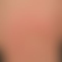 Urticaria pigmentosa: classic form of urticaria pigmentosa (type I). disseminated, flat, oval or ...