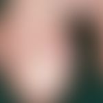 Fibrokeratome, acquired digital. benign, mainly on the fingers, more rarely on the toes, very slo...