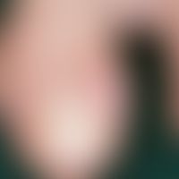 Fibrokeratome, acquired digital. benign, mainly on the fingers, more rarely on the toes, very slo...