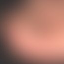 Fibrokeratom, erworbenes, digitales. Seit 7 Jahren bestehender, gering größenprogredienter, druck...