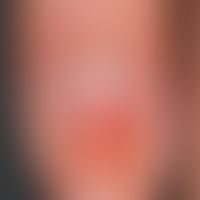 Ölfleck, psoriatischer:&nbsp; wenig scharf abgegrenzter bräunlicher Fleck. Immer wieder auftreten...