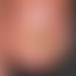 Oil stain, psoriatic: Subungual infection of the left ring finger. Sharply defined lesions. Perip...