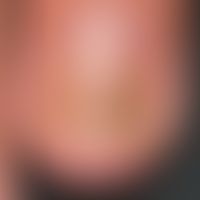 Ölfleck, psoriatischer: subungualer&nbsp;Befall des linken Ringfingers. Scharf abgegrenzte geblic...