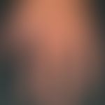 Psoriasis palmaris (as partial symptom of a generalized poriasis): Subungual infection of the lef...