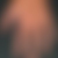 Psoriasis palmaris (als Teilsymptom einer generalisierten Poriasis):&nbsp;Subungualer&nbsp;Befall...