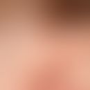 ear fistula and cyst, congenital (bds). findings congenital. no complaints so far. external fistu...
