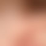 ear fistula and cyst, congenital (bds). findings congenital. no complaints so far. external fistu...
