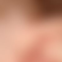 ear fistula and cyst, congenital (bds). findings congenital. no complaints so far. external fistu...