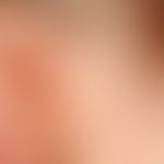 ear fistula and cyst, congenital (bds). findings congenital. no complaints so far. external fistu...