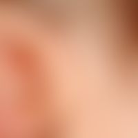 ear fistula and cyst, congenital (bds). findings congenital. no complaints so far. external fistu...