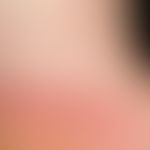 Lichen planus. for several weeks persistent, itchy, polygonal, partly confluent, red, smooth papu...