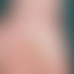 Lichen planus. chronic progressive form (present in this form for about 1 year). plaque-shaped hy...