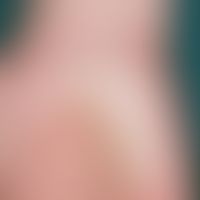 Lichen planus. chronic progressive form (present in this form for about 1 year). plaque-shaped hy...