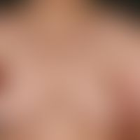 Lipomatosis, benign symmetrical - type II - pseudoathletic type.
