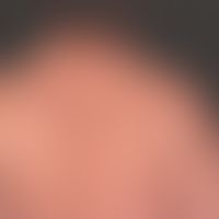 Lipomatose benigne symmetrische: Schultergürtel- oder pseudoathletischer Typ.
