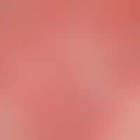 Pustulose, akute generalisierte exanthematische.&nbsp;Haut in Abheilung.&nbsp;Charakteristische&n...