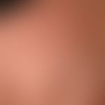 Acne comedonica. general view: Recurrent multiple, disseminated standing retention cysts of 0.3-1...