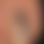 Mlelanom malignes akrolentiginöses: Subunguales malignes Melanom. Charakteristisch ist das streif...