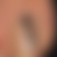 Mlelanom malignes acrolentiginous: Subungual malignant melanoma. Characteristic is the stripy gro...
