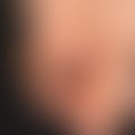 Melanom, malignes, akrolentiginöses: Komplette Zerstörung des Nagelorgans durch das Tumorwachstum...
