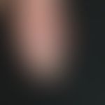 Melanom, malignes, akrolentiginöses: Komplette Zerstörung des Nagelorgans durch das Tumorwachstum...