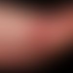 Amelanotisches akrolentiginöses malignes Melanom: Seit Jahren bestehender, "rötlicher Fleck".&nbs...