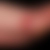 Amelanotic acrolentiginous malignant melanoma: A "reddish spot" that has existed for years. It is...