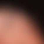 Melanom malignes akrolentiginöses: Seit vielen Jahren bestehender brauner "Fleck" an der linken K...