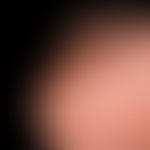 Akrolentiginöses malignes Melanom: Seit Jahren bestehender, brauner sich langsam vergrößernder Fl...