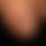 Melanom, malignes, akrolentiginöses.&nbsp; Breite, braune, durchgehende Verfärbung der Nagelplatt...