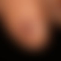 melanoma, malignant, acrolentiginous. broad, brown, continuous discoloration of the nail plate. f...