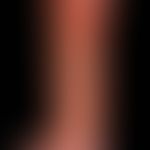 Large ulcer of thegaiter, covering almost the entire lower leg, with a circumferential ulcer in c...