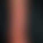 Circumferentialulcer covering almost the entire lower leg in chronic venous insufficiency (see in...