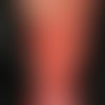 gaiter ulcer. large, yellowish ulcer in the calf area in a 61-year-old female patient with lymphe...