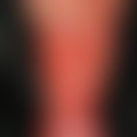 gaiter ulcer. large, yellowish ulcer in the calf area in a 61-year-old female patient with lymphe...