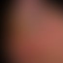 Fußsyndrom, diabetisches, nachgwiesene schwere Polyneuropathie, Malum perforans und augeprägtem g...