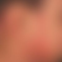 Psoriasis vulgaris. generalized psoriasis with nummular, dry scaling plaques in a 12-year-old boy...