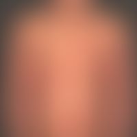 Psoriasis vulgaris. chronic, inpatient psoriasis with little relapse activity. general view: mult...