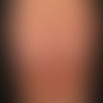 Atrophodermia idiopathica et progressiva: Large, red, confluent, barely palpable, smooth, sharply...