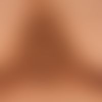 papillomatosis confluens et reticularis. since several years increasing discoloration and thicken...