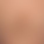 Papillomatosis confluens et reticularis: Patchy and flat, velvety yellow-brown plaques (harmless ...