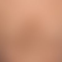 Papillomatosis confluens et reticularis: Patchy and flat, velvety yellow-brown plaques (harmless ...