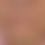 Perlèche: Chronic macerative dermatitis in age-involuted lips with superimposed lips and hypersal...