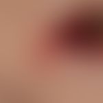 Perlèche: Chronic macerative dermatitis in age-involuted lips with superimposed lips and hypersal...