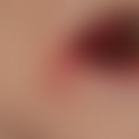 Perlèche: Chronische mazerative Dermatitis bei altersinvolutierten Lippen mit Aufeinanderliegen&n...