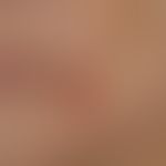 Perlèche: Chronic macerative dermatitis in age-involuted lips with superimposed lips and hypersal...