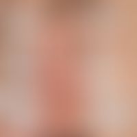 Airborne Contact Dermatitis: Testergebnis der Epikutantestung.
