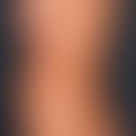 Pityriasis rosea. truncated, díchtes maculopapular exanthema arranged in the cleft lines, little ...
